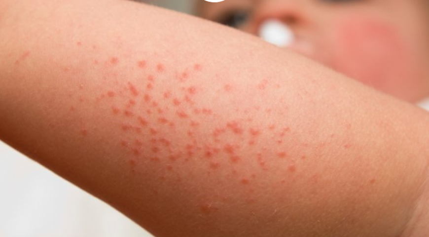 Tips Hilangkan Eczema Cara Semulajadi
