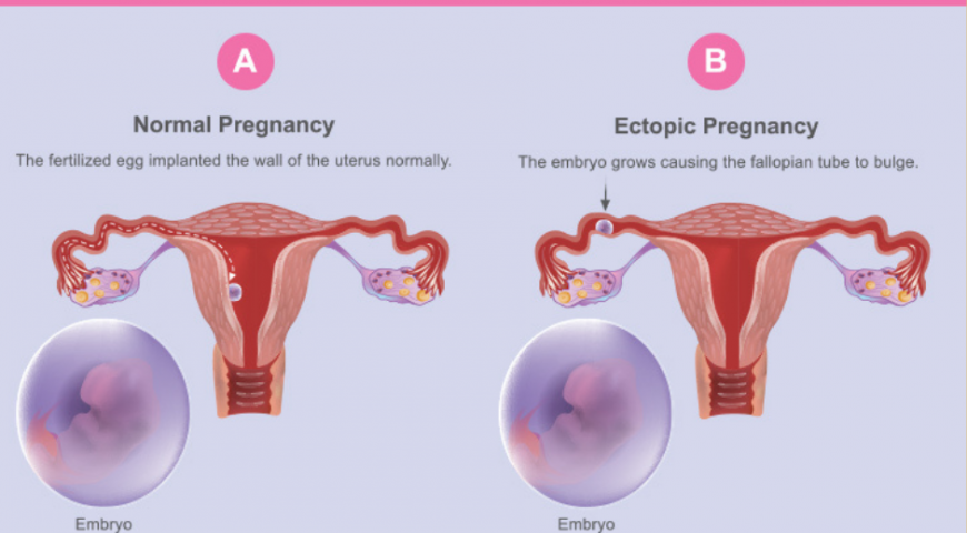 Kehamilan di luar rahim